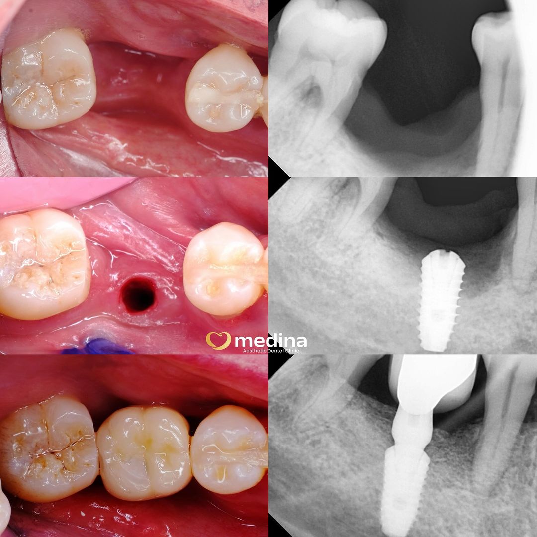 IMPLANT GIGI DOKTER GIGI JEPARA 