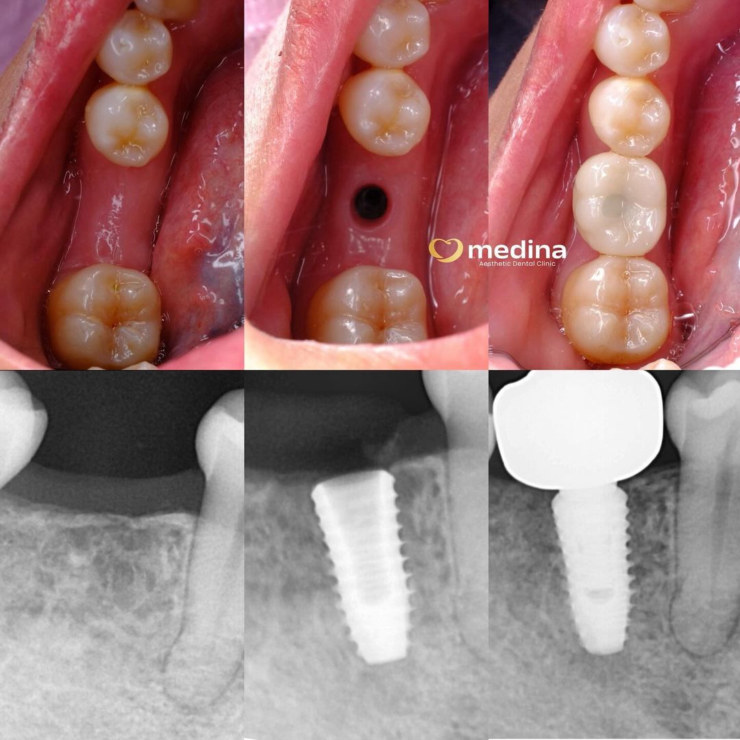 IMPLANT GIGI DOKTER GIGI JEPARA 