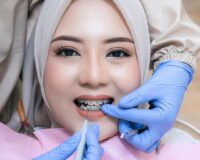 KENAPA BRACKET SERING LEPAS? KLINIK GIGI JEPARA MEDINA