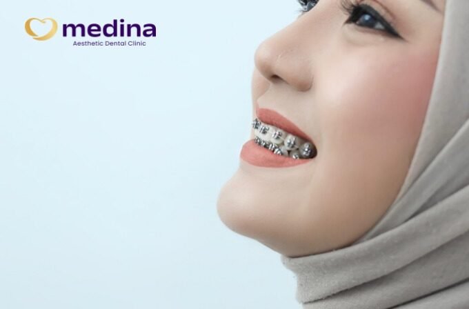 UMUR 10 TAHUN SUDAH PASANG BEHEL?