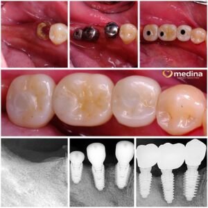 IMPLANT GIGI JEPARA
