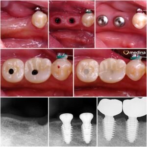 IMPLANT GIGI JEPARA