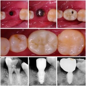 IMPLANT GIGI JEPARA