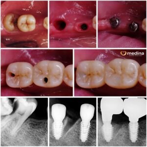 IMPLANT GIGI JEPARA