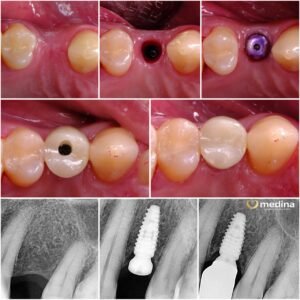 IMPLANT GIGI JEPARA