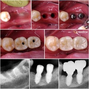 IMPLANT GIGI JEPARA